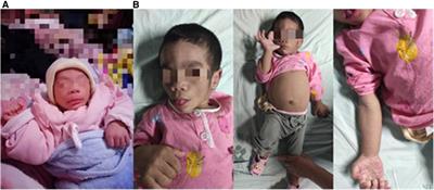 Case report: Echocardiographic diagnosis of cardiac involvement caused by congenital generalized lipodystrophy in an infant